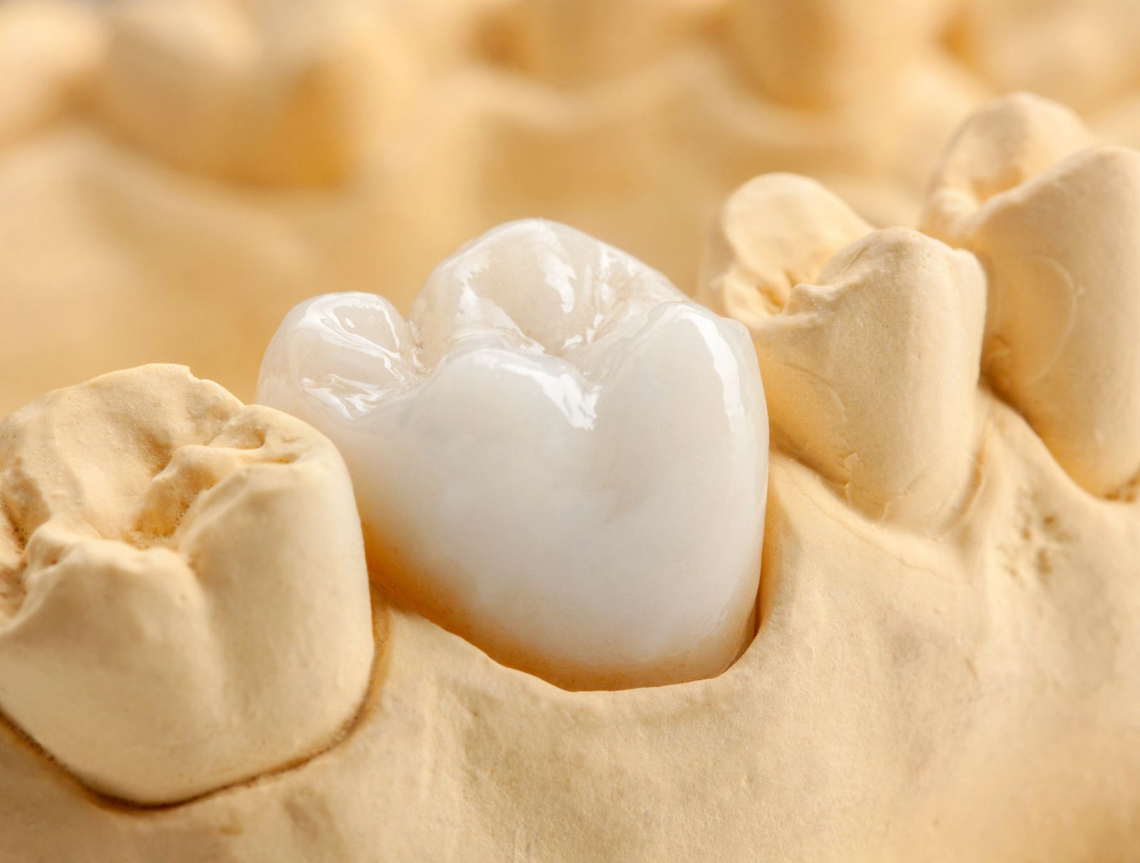 A Comprehensive Guide to Same-Day Dental Crowns: Benefits, Process, and Aftercare
