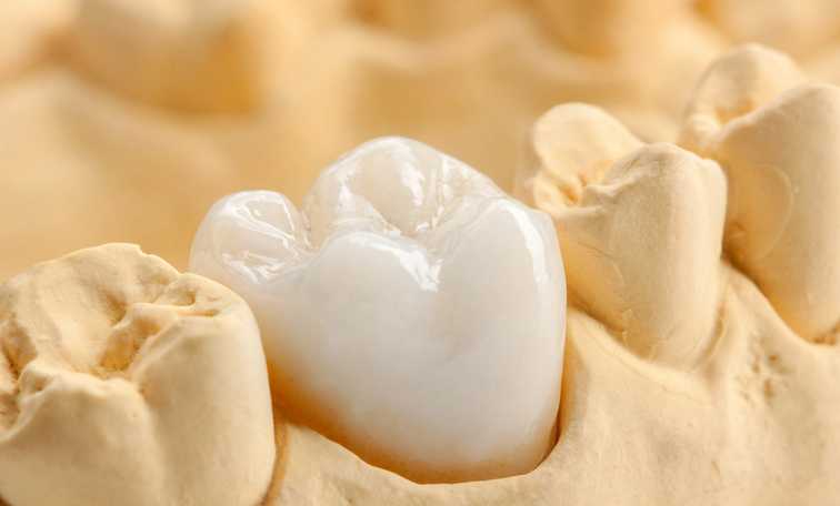 Embrace the Convenience of Same-Day Dental Crowns for a Restored Smile