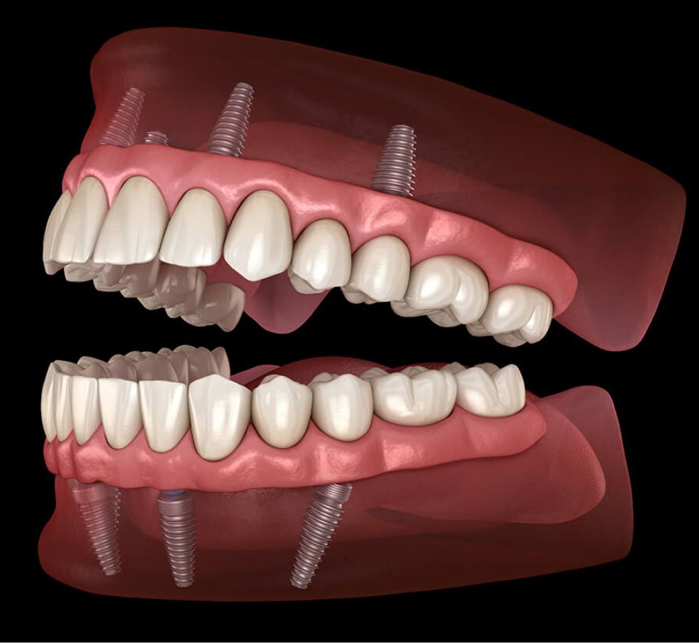 All-On-4 Dental Implants