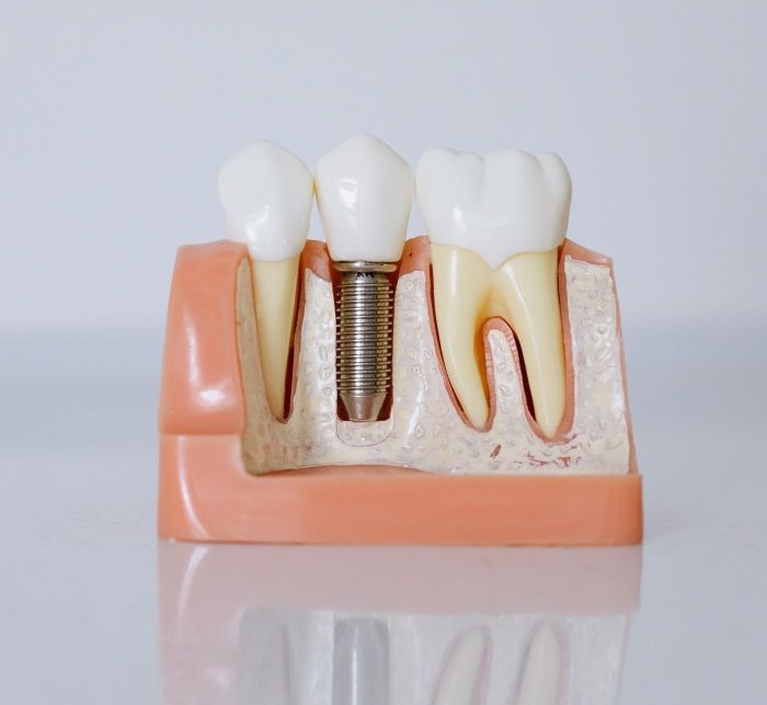 dental implants