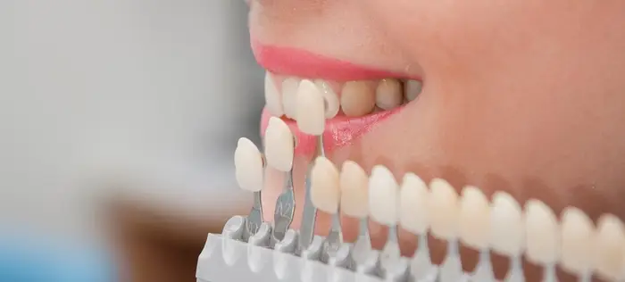 Enhancing Your Smile with Porcelain Veneers: Discover the Possibilities at Chamberlain Dental